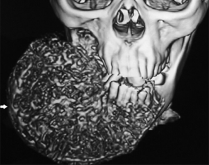 38-year-old female patient with a huge swelling on the right side of the face diagnosed with calcifying epithelial odontogenic tumor. A multidimensional computed tomography reconstruction using a hard tissue algorithm exhibits the extent of the well-circumscribed giant tumor (white arrow).
